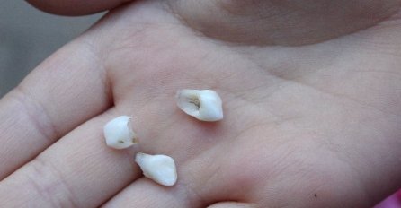 SANJALI STE DA SU VAM ISPALI ZUBI?:  Evo šta to znači i šta trebate ODMAH URADITI