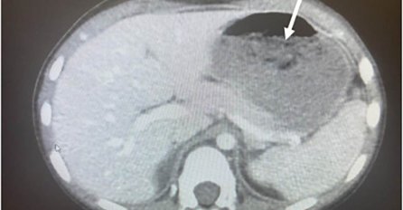 DJEČAK PROGUTAO 40 ŽVAKA, RODITELJI U PANICI: Evo koje su posljedice i da li ostaje u tijelu ZAUVIJEK - može da napravi HAOS