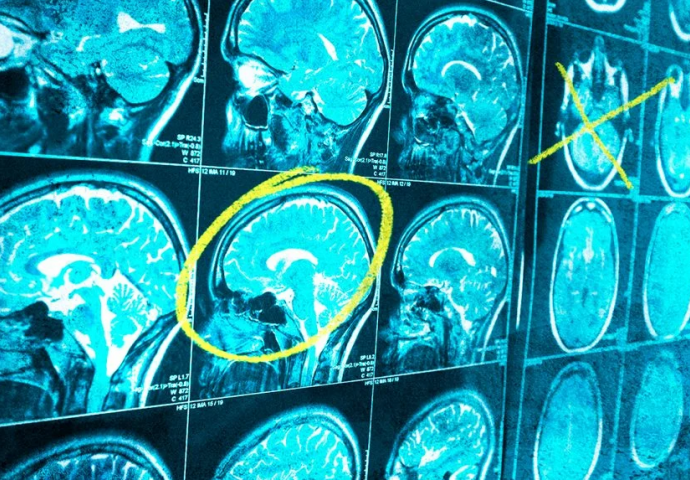 Simptomi tumora na mozgu: OVO SU OZBILJNI ZNAKOVI UPOZORENJA - prvi simptom skoro svi ignorišu
