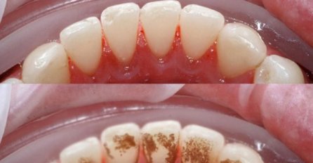 Samo jednim sastojkom riješite se zubnog kamenca, plaka i bakterija: OVAJ SASTOJAK VEĆ IMATE U KUĆI