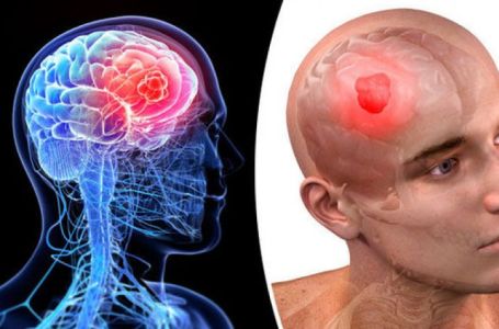 Neurolog otkrio koji se simptomi mogu javiti danima prije moždanog udara