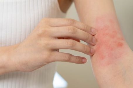 UKAZUJU NA ZDRAVSTVENE PROBLEME: Ove promjene na koži su alarm za uzbunu