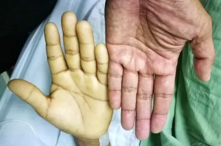 GLAVNI SIMPTOMI ANEMIJE NE SMIJU SE IGNORISATI: Evo koje namirnice poboljšavaju hemoglobin