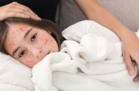 Dom zdravlja Bijeljina prijavio epidemiju morbila