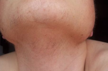 ZNATE LI ZAŠTO SE KOD ŽENA JAVLJAJU DLAČICE NA BRADI? Evo šta je uzrok dlakavosti lica kod žena