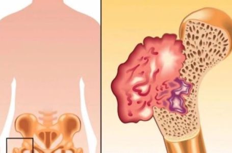 B0L U KOSTIMA, VIS0K PRITISAK I TUGA:  Simptomi da vam u tijelu nedostaje ovaj VAŽAN VITAMIN