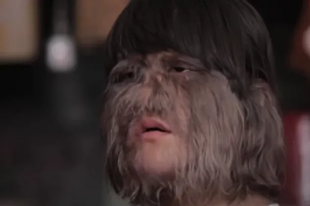 NAJDLAKAVIJU DJEVOJČICU NA SVIJETU ZVALI SU VUKODLAK: Obrijala je lice i evo kako izgleda