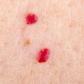 Imate li ovakve crvene tačkice po koži? Ovo su razlozi zašto se pojave i kada treba ići doktoru