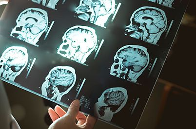 5 RANIH ZNAKOVA DEMENCIJE: Uočite ih na vrijeme i usporite njeno napredovanje