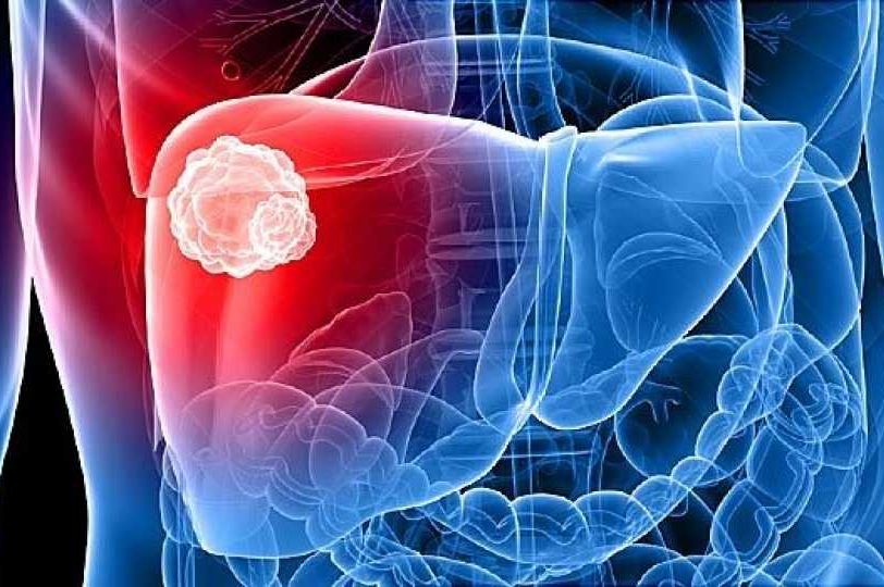Da li ste se ikada zapitali kako nastaje masna jetra: OVO SU UZROCI I SIMPTOMI