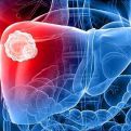 Da li ste se ikada zapitali kako nastaje masna jetra: OVO SU UZROCI I SIMPTOMI