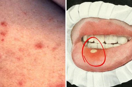 Ova bolest je sve češća, a simptomi su sve jači i čudniji