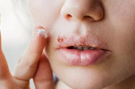 KAD IZAĐE, SVI KAŽU: "PAO TI JE IMUNITET"!  Evo zbog čega nastaje HERPES i koliko dugo traje