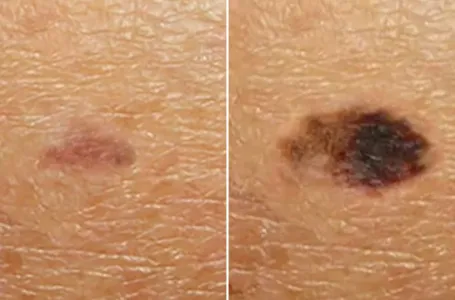 Zastrašujući video otkriva kako se sićušna tamna mrlja može pretvoriti u 4. stepen raka kože (VIDEO)