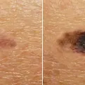 Zastrašujući video otkriva kako se sićušna tamna mrlja može pretvoriti u 4. stepen raka kože (VIDEO)