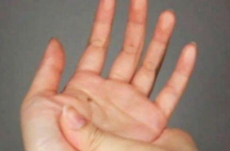 OBIČAN OSIP NA ŠAKAMA MOŽE BITI ZNAK NEPRIJATNOG STANJA: Ako vidite OVO hitno se obratite ljekaru