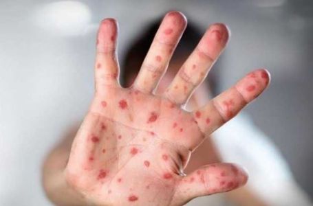 Alarmantno stanje: Proglašena epidemija morbila u jednom bh. gradu