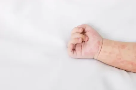 Morbili ponovo haraju: Kako možete prepoznati ovu bolest?