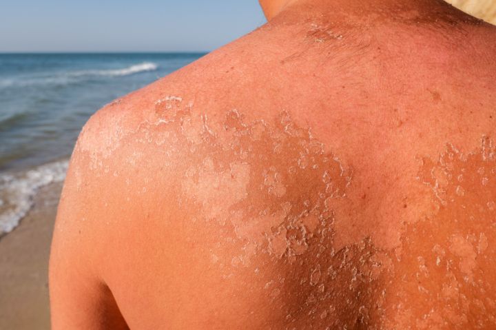 Evo kako se riješiti ‘paklenog’ svrbeža i opeklina od sunca