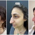 Tri sestre operisale noseve: REZULATAT JE NEVJEROVATAN, evo kako izgledaju sada