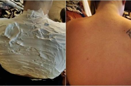 100 puta bolje od jogurta: Izgorjela je na suncu, a ovo je spasilo za pola sata