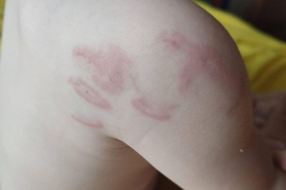 Oglasila se policija: Poduzimaju se mjere u vezi sa slučajem povređivanja djeteta u vrtiću