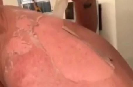 Doktor upozorava da ne gulite kožu koja je izgorjela na suncu: NISTE NI SVJESNI ŠTA MOŽE DA SE DESI