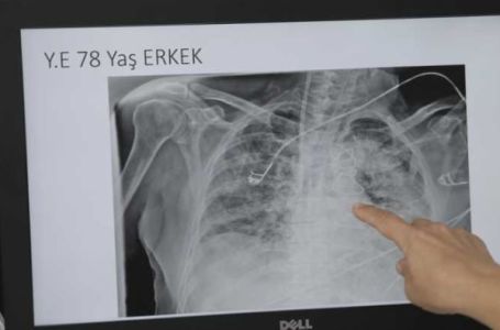 Raste broj oboljelih od atipične upale pluća u regiji: Obratite pažnju na ove simptome