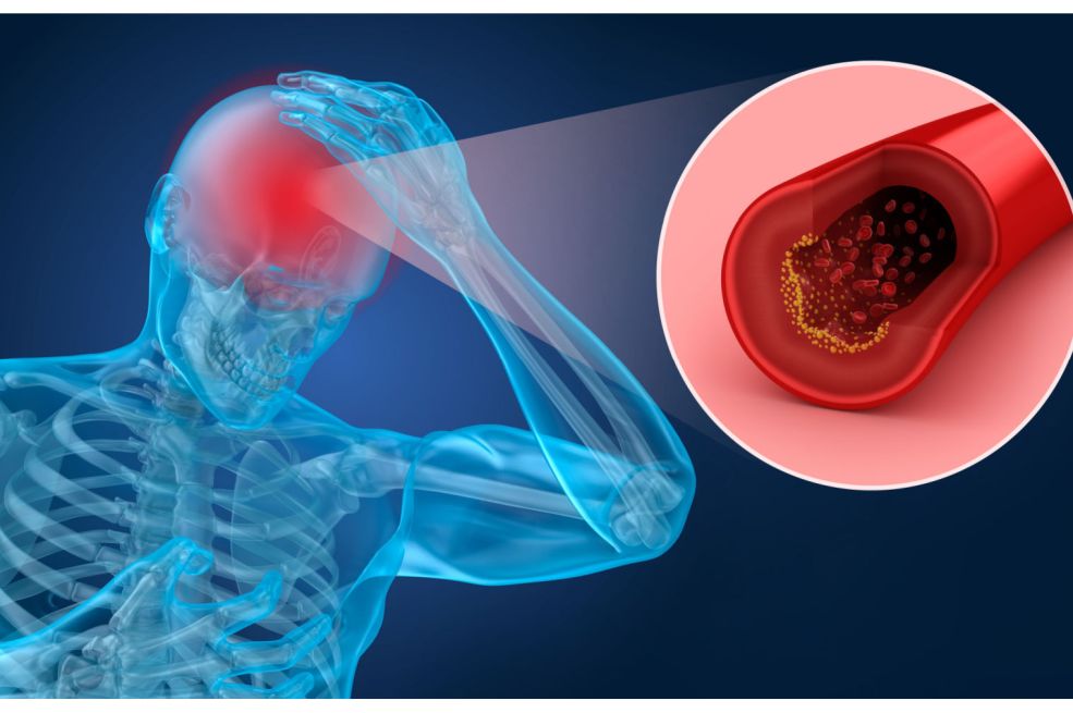 Neurolog otkrio koji se simptomi mogu javiti danima prije moždanog udara