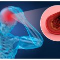 Neurolog otkrio koji se simptomi mogu javiti danima prije moždanog udara