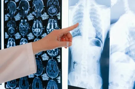 Rani znak raka pluća: Jednostavan test prsta može upozoriti na simptome