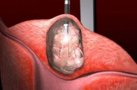 ZBOG RAKA MATERICE UGROŽEN SVE VEĆI BROJ ŽENA: Ovaj tumor ima 6 JASNIH SIMPTOMA
