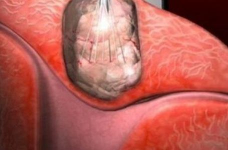 ZBOG RAKA MATERNICE UGROŽEN SVE VEĆI BROJ ŽENA: Ovaj tumor ima 6 JASNIH SIMPTOMA
