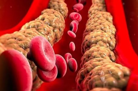 Tri jednostavne navike koje bi mogle sniziti holesterol