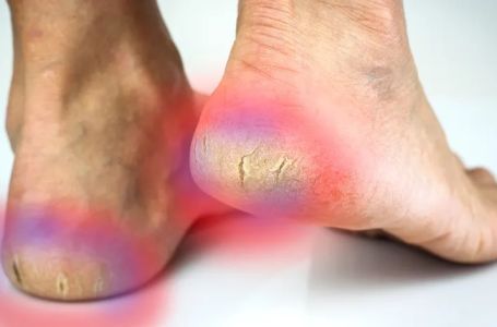 Jeftina namirnica rješava ispucale pete, kurje oči i gljivice na stopalima: IMAMO JE U KUĆI