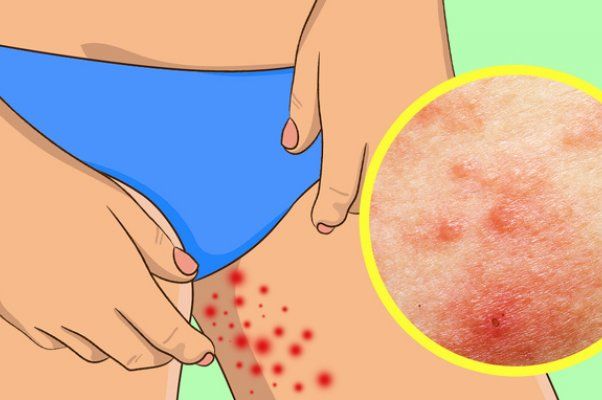 KORISNI SAVJETI: Kako da se riješite problema koji svako ljeto muče sve žene?!