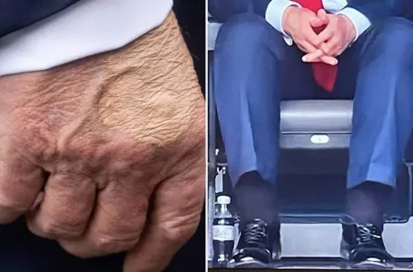 Otečeni članci i ruka u modricama: Bijela kuća se oglasila o TRUMPOVOM STANJU, evo šta je u pitanju