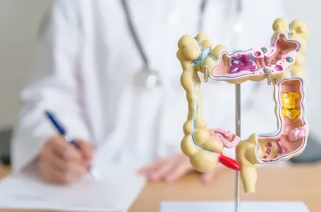 Nagli porast raka debelog crijeva među mladima: Naučnici otkrili moguće uzroke