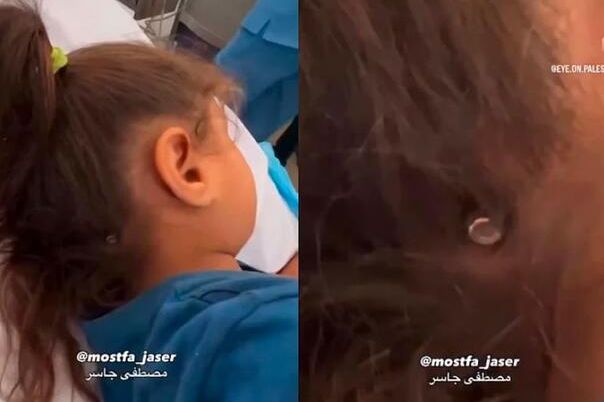 Djevojčica iz Gaze preživjela pogodak metkom u glavu