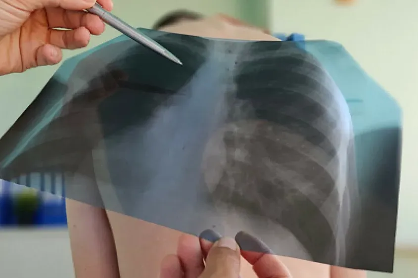 Otišao na rendgen pluća, šokirao doktore: Nisu mogli vjerovati što se nalazilo u njegovim prsima