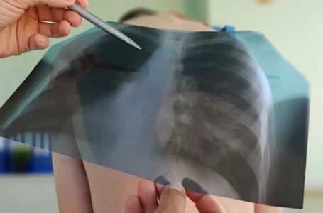 Otišao na rendgen pluća, doktori u šoku: Evo šta se nalazilo u njegovim prsima punih 8 godina