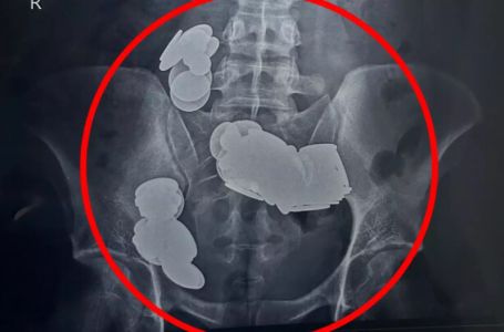 Muškarac tražio pomoć zbog jakih bolova u trbuhu, ljekari u nevjerici zbog onog što su našli