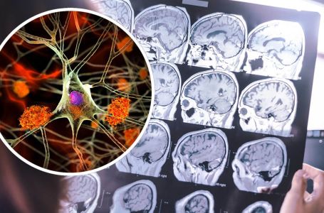 Ovo su simptomi demencije koji se javljaju puno prije gubitka pamćenja