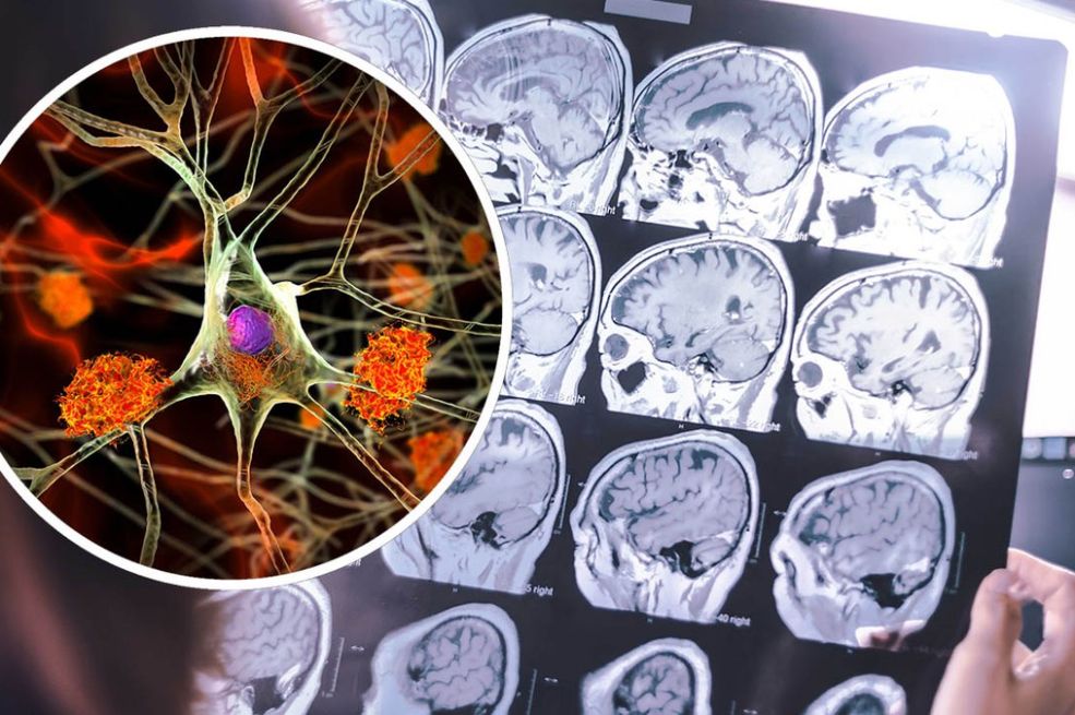 Ovo su simptomi demencije koji se javljaju puno prije gubitka pamćenja