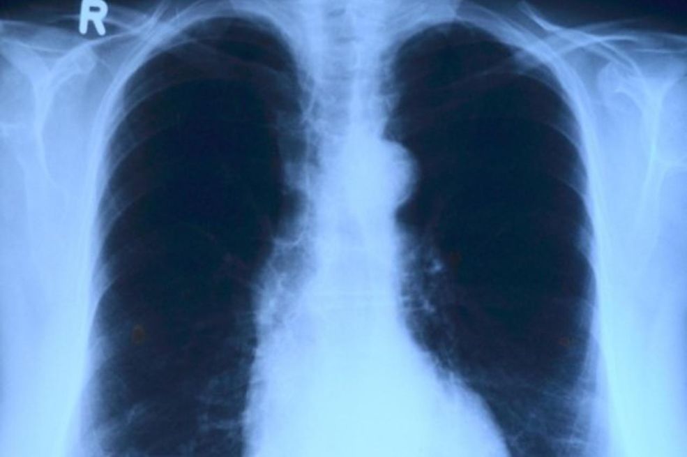 Opaka bolest u porastu, izdali upozorenje građanima: Ovo su simptomi