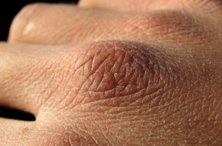 Puca vam koža, opada kosa ili imate grčeve? Tijelo vam govori da vam nedostaju ovi vitamini