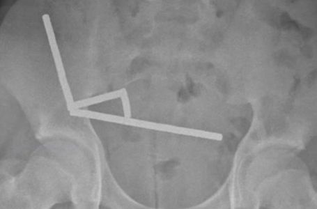 Dječak (13) primljen u bolnicu s jakim bolovima: Evo šta su ljekari pronašli u njegovim crijevima