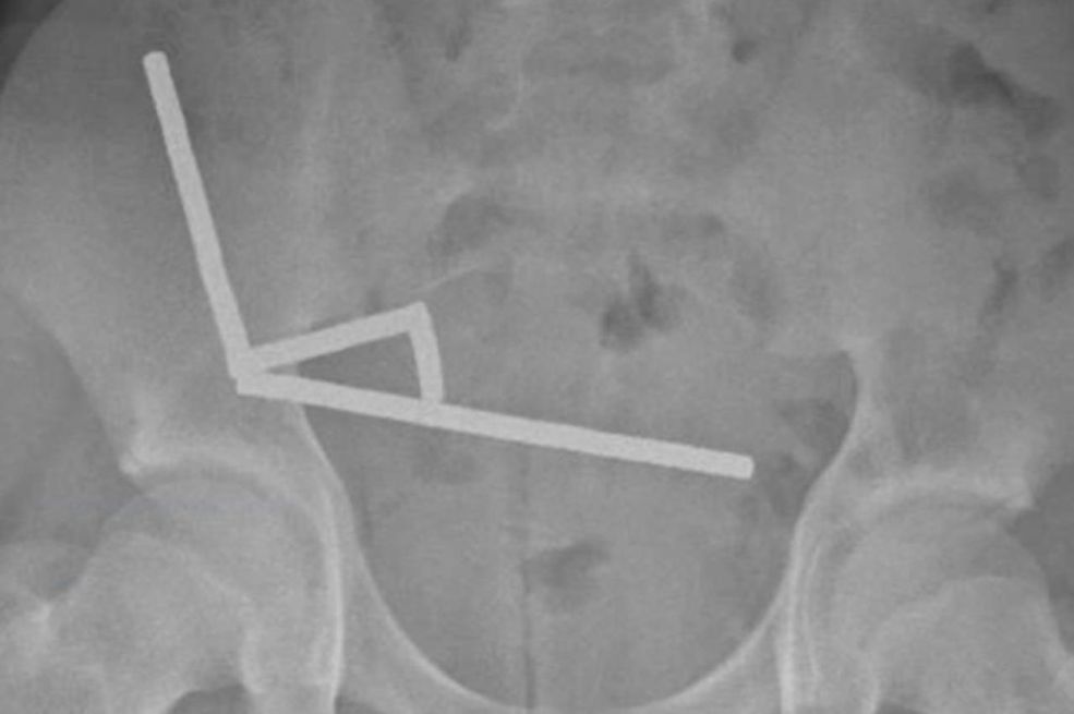 Dječak (13) primljen u bolnicu s jakim bolovima: Evo šta su ljekari pronašli u njegovim crijevima