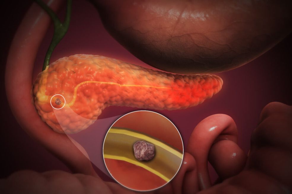 Ovo su glavni okidači za upalu pankreasa