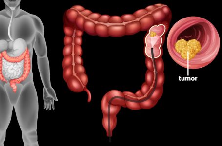 Ova jednostavna navika može smanjiti rizik od raka debelog crijeva za čak 40 %!